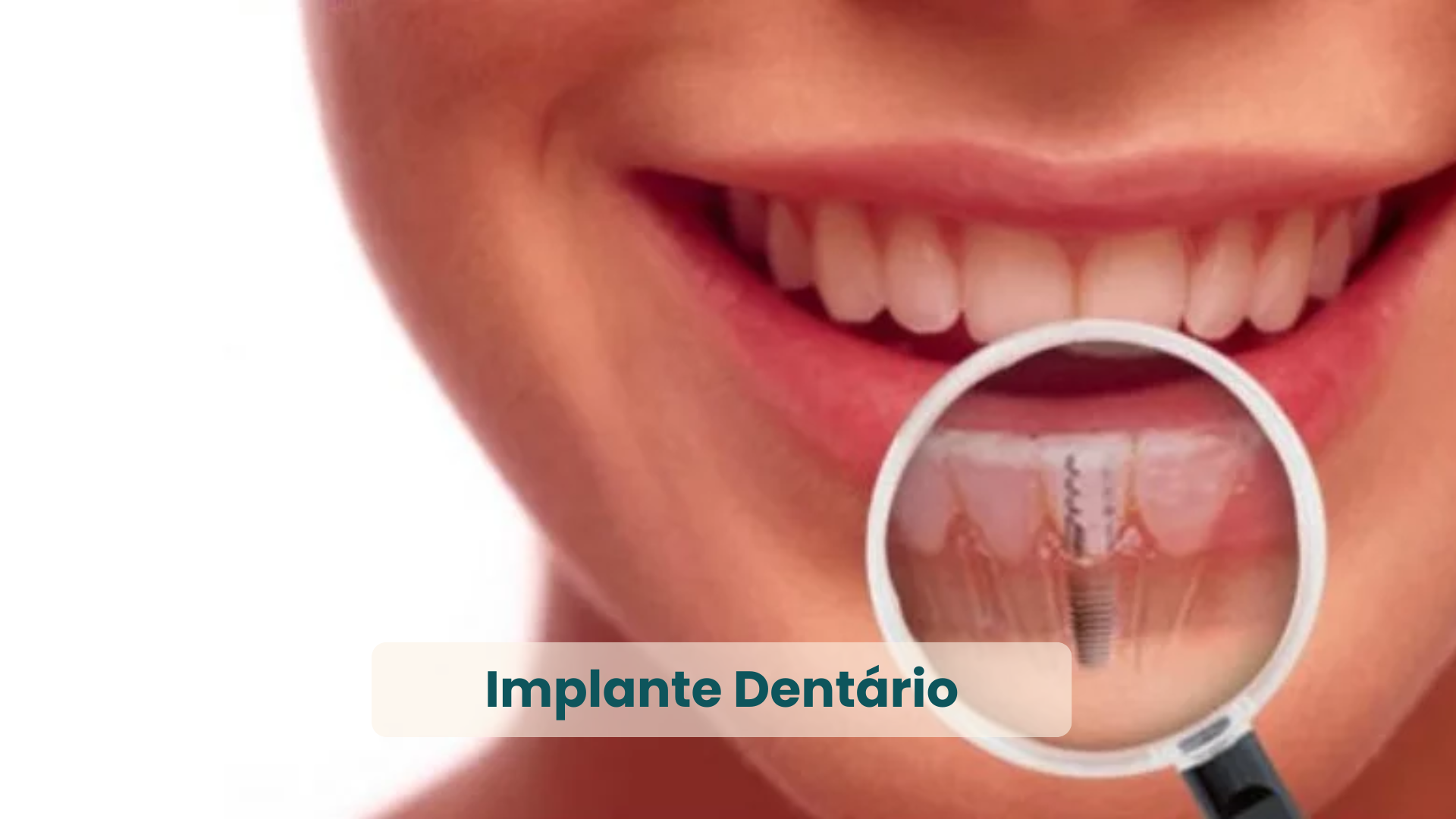 Clínica Odontológica em Natal, com as principais Especialidades (Implantes)
