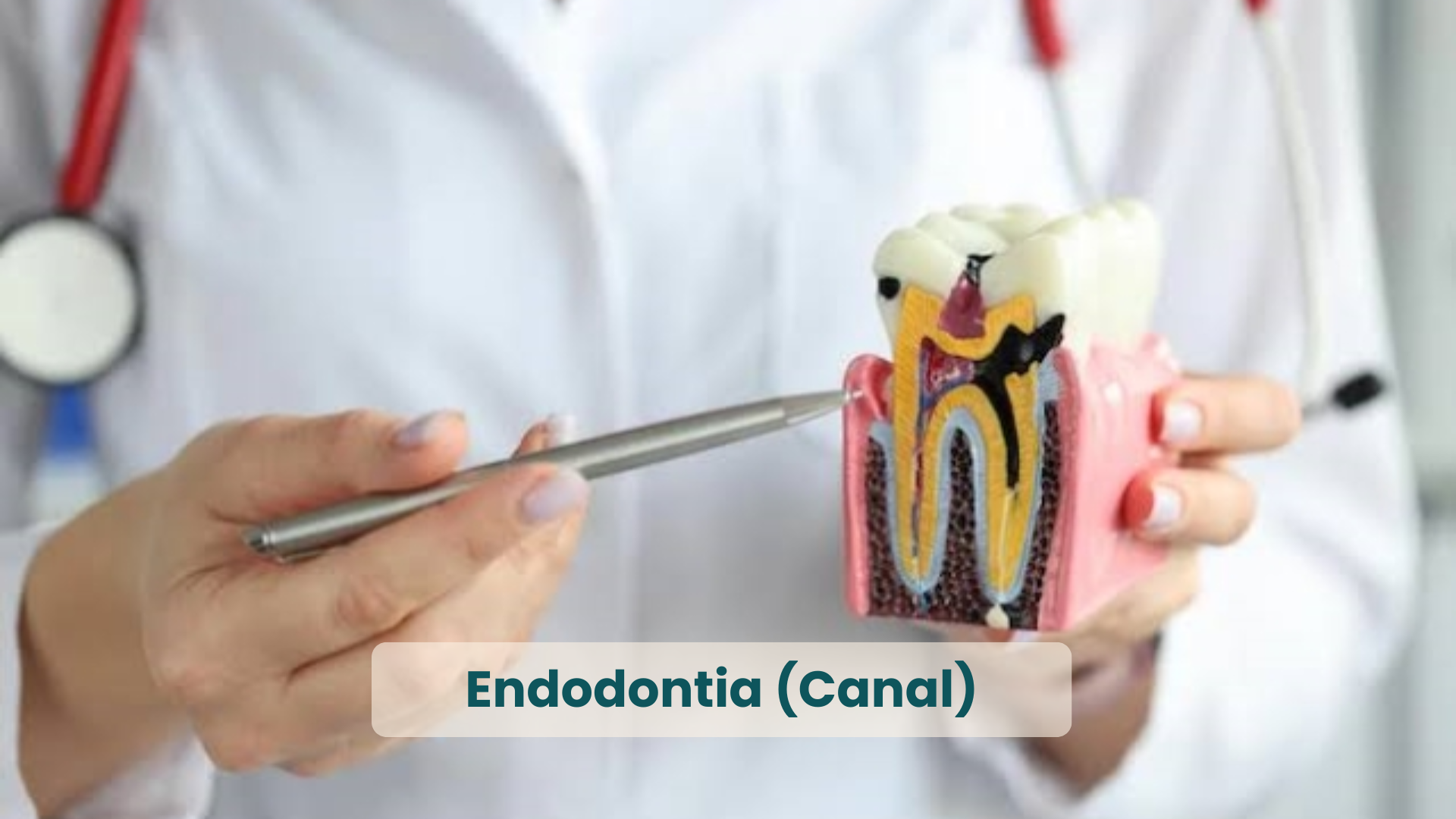 Clínica Odontológica em Natal, com as principais Especialidades_ Endodontia (Canal)