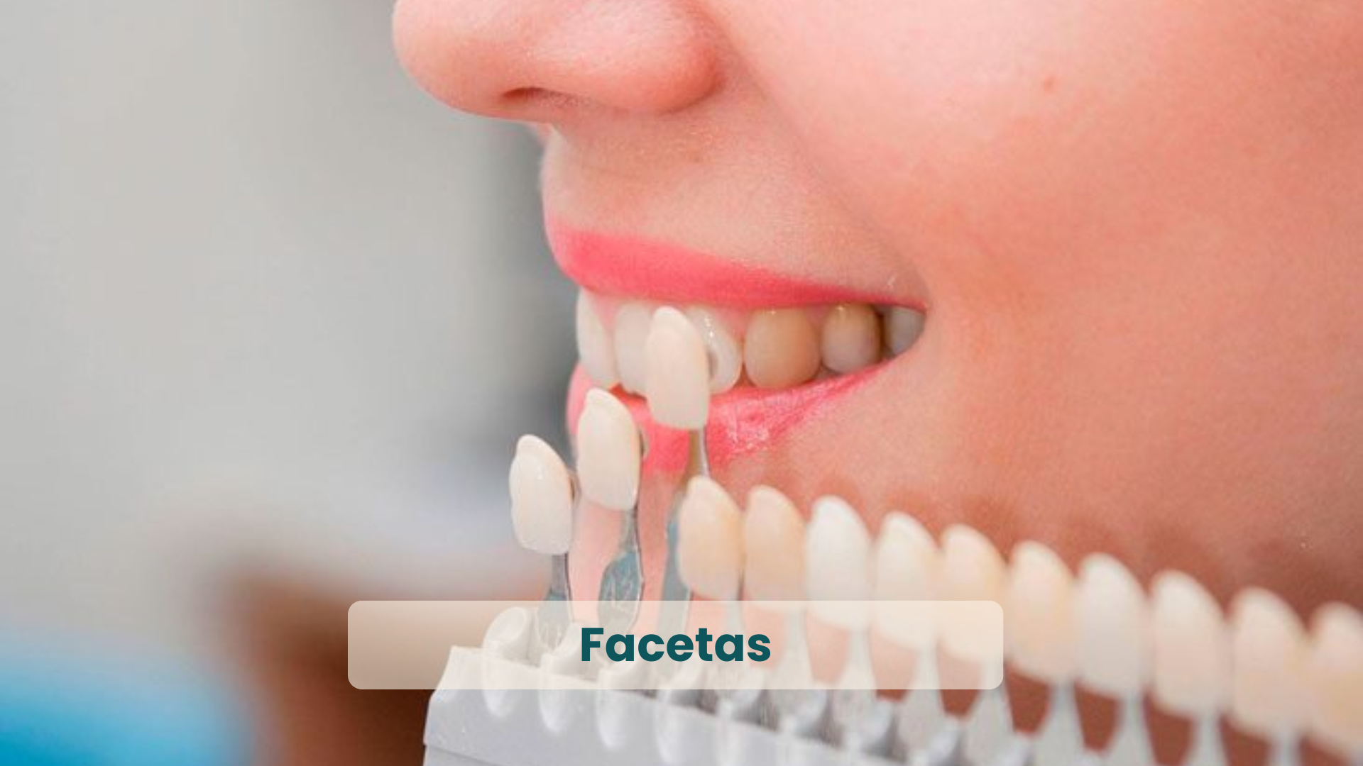 Clínica Odontológica em Natal, com as principais Especialidades_ Facetas