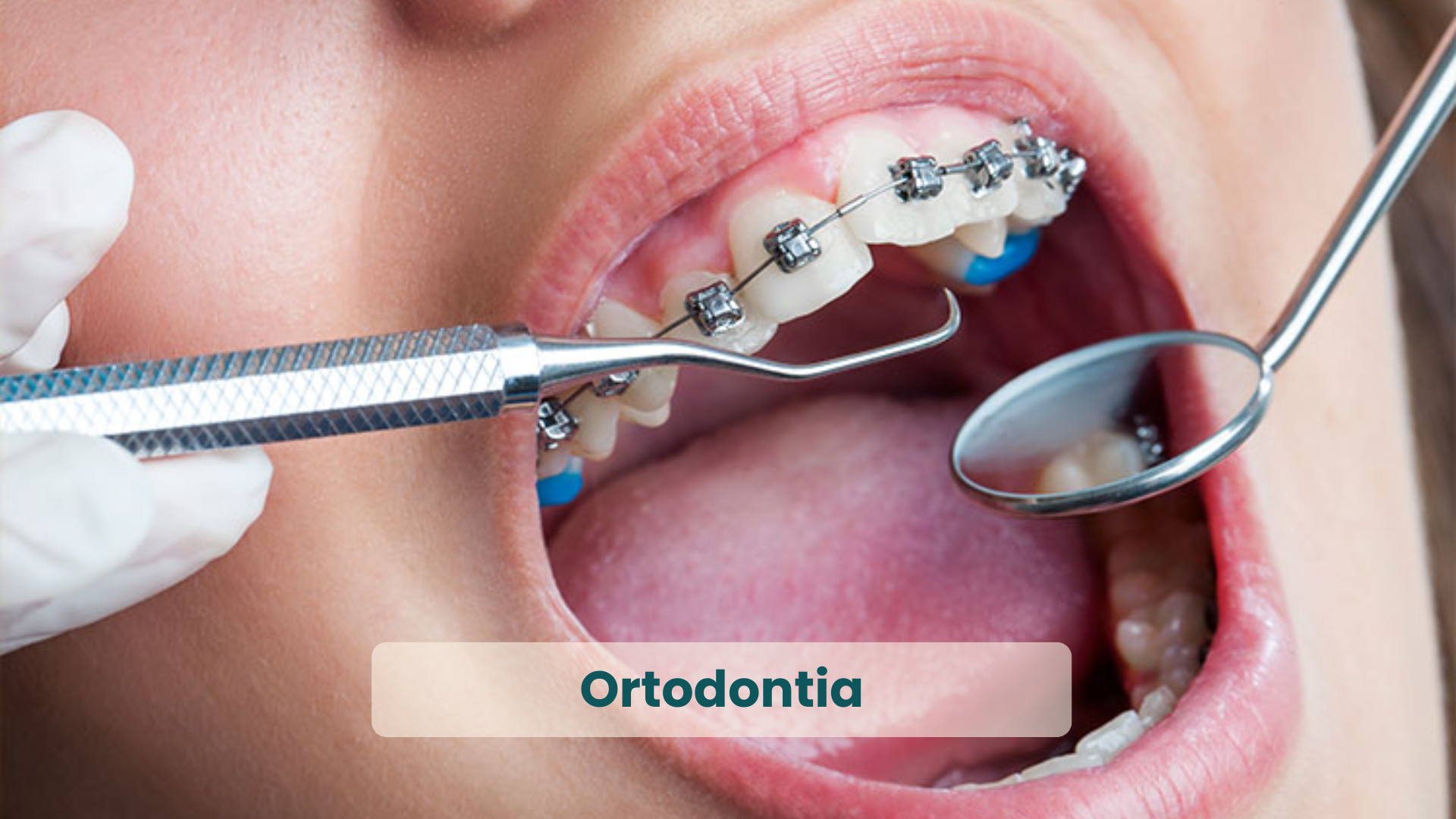 Clínica Odontológica em Natal, com as principais Especialidades_ Ortodontia