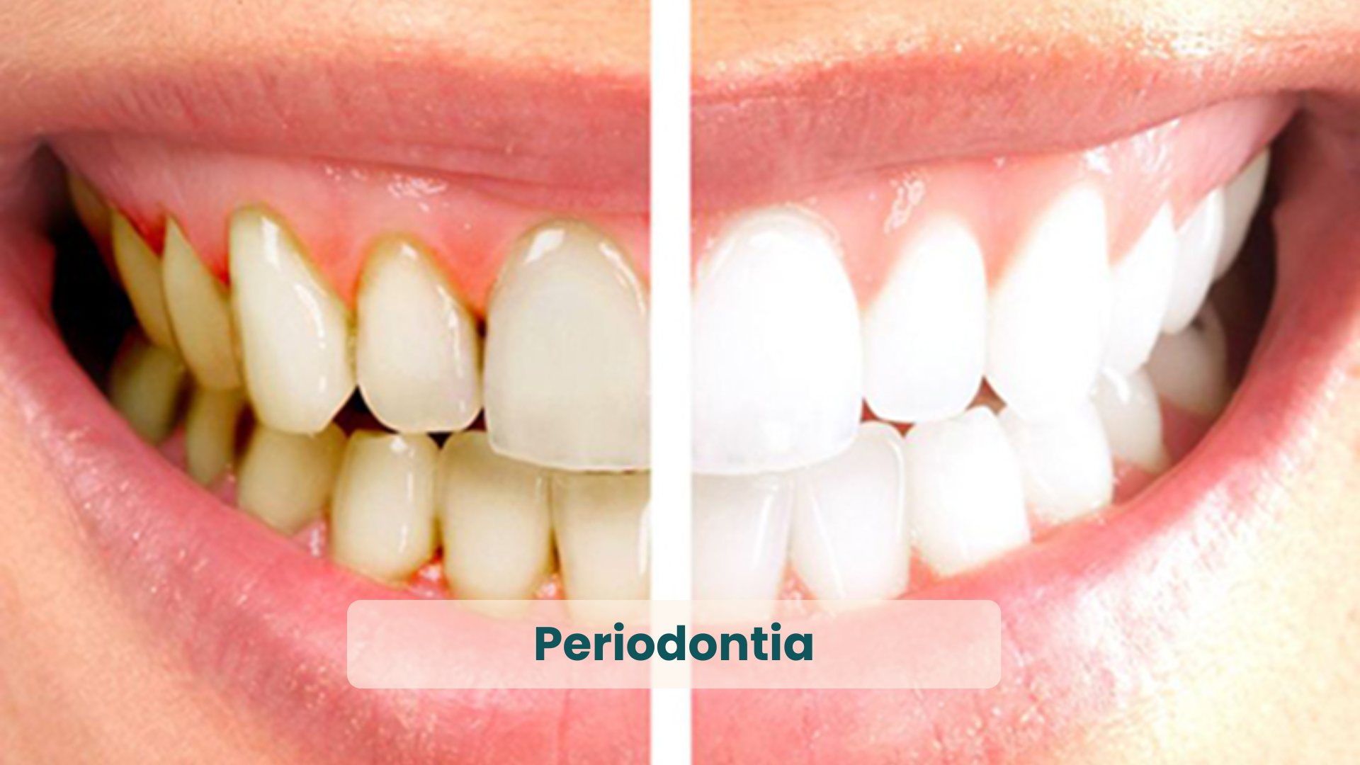 Clínica Odontológica em Natal, com as principais Especialidades_ Periodontia
