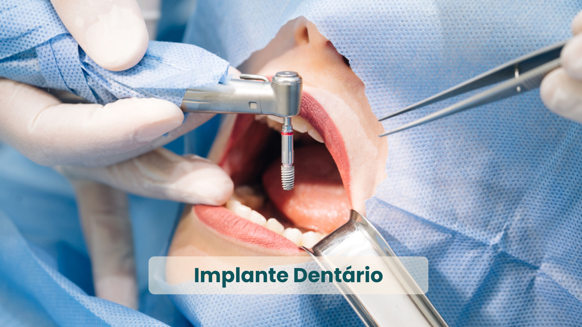 Especialidades e serviços odontológicos da Clínica Dualle_ Implantes Dentários