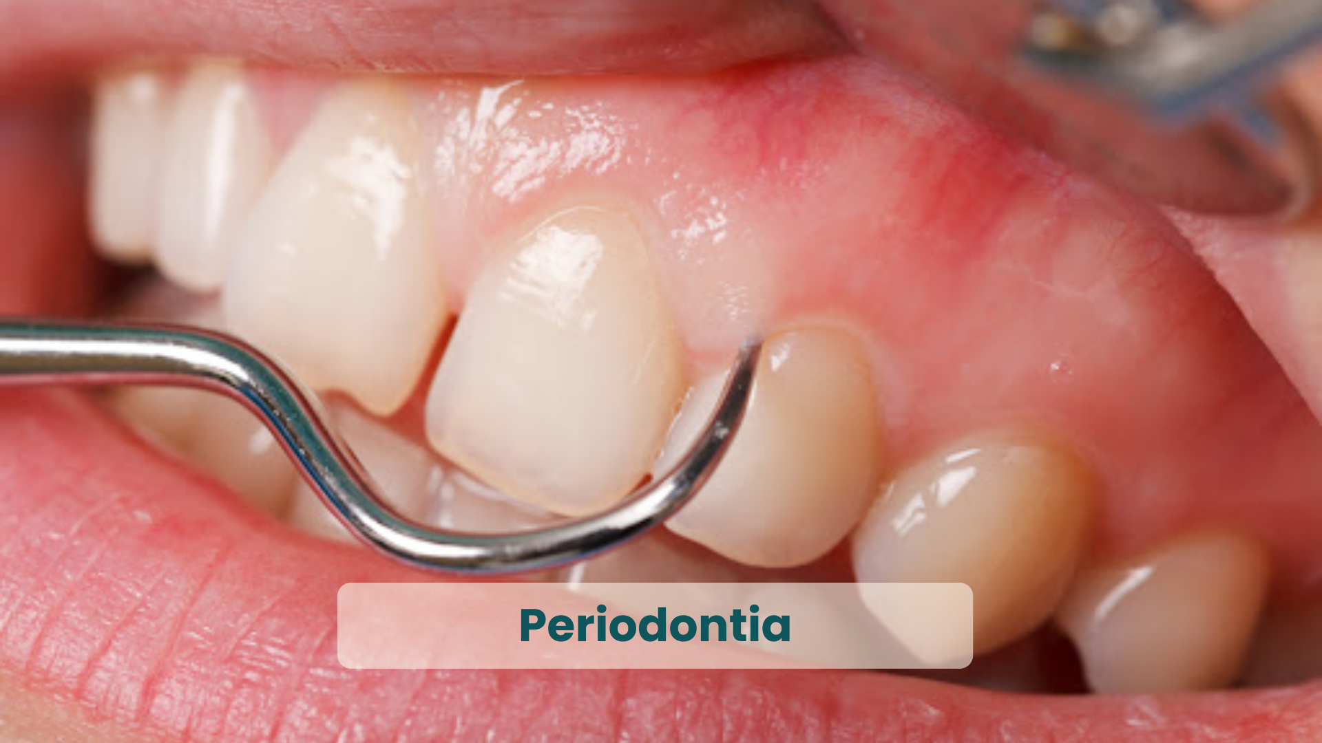Melhores Dentistas de Natal RN, em Periodontia